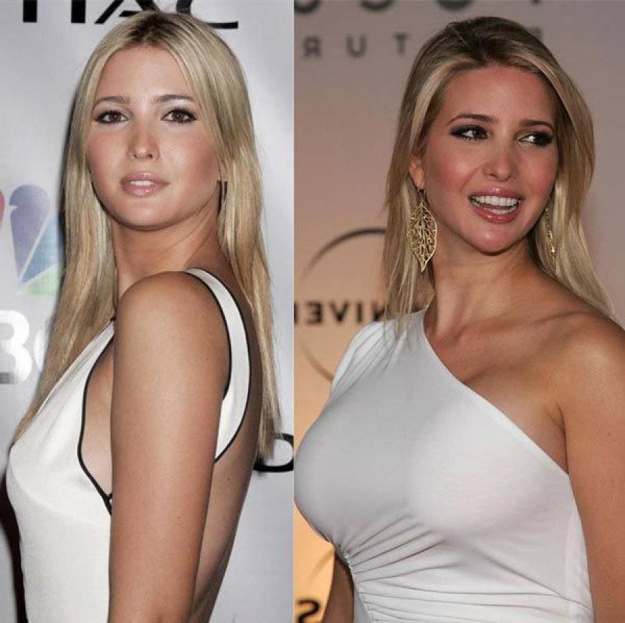 Breast implants before and after celebrities