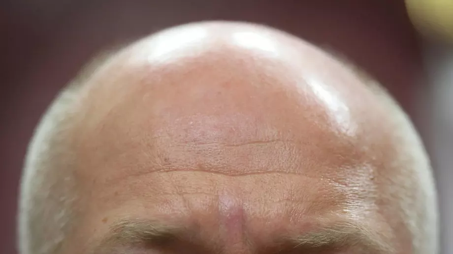 Защо мъжете, които работят много, оплешивяват