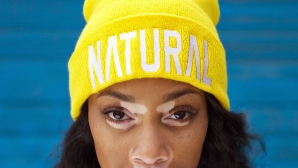 Шантел Браун - уникален модел с рядко кожно заболяване