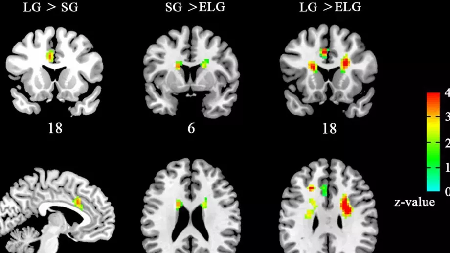Учени установиха как излишните килограми влияят на мозъка ни