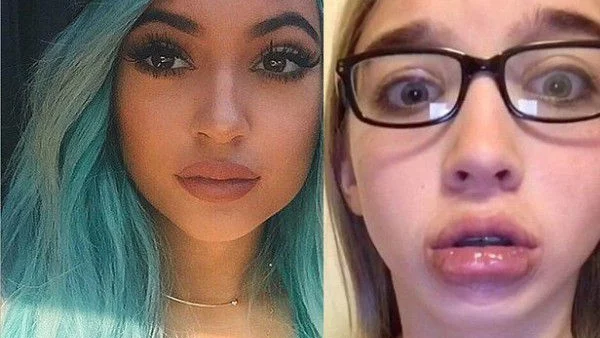 Нова мания - тийнове си правят като устните на Кайли Дженър