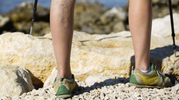 Как да предотвратим появата на разширени вени