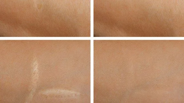 Домашен крем срещу белези