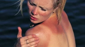 6 народни рецепти при слънчево изгаряне