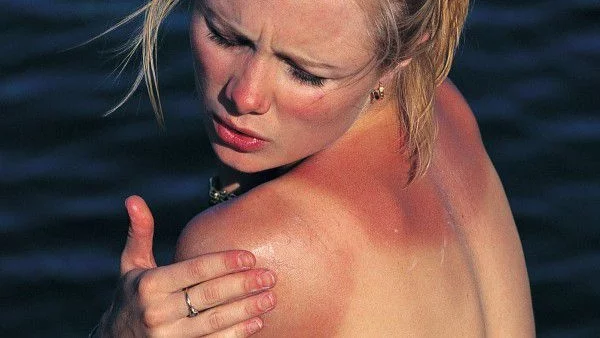 6 народни рецепти при слънчево изгаряне