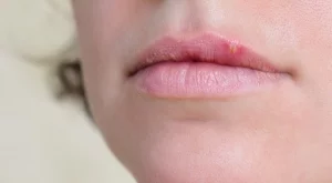 5 заблуди за херпеса