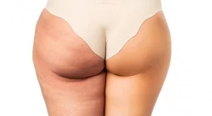 Как да се сбогуваме с целулита