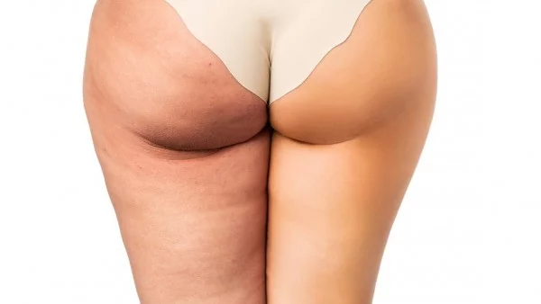 Как да се сбогуваме с целулита