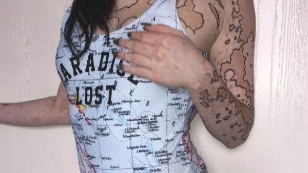 Момиче, тормозено заради витилигото си, го превърна в изкуство