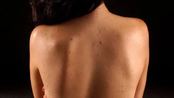 Най-честите причини за акне и как да се справим с него