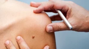 Безплатни прегледи за рак на кожата