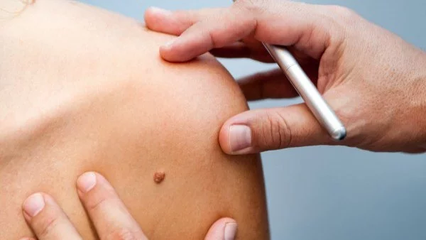 Безплатни прегледи за рак на кожата