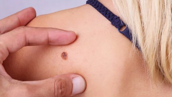 Безплатни прегледи за рак на кожата в 21 града