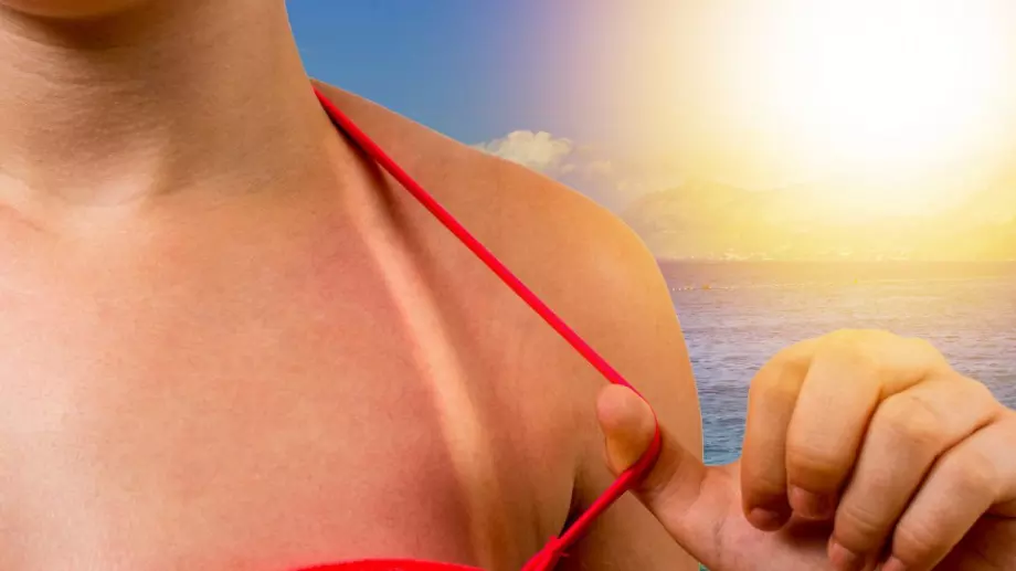 Изпитани натурални средства при слънчево изгаряне   