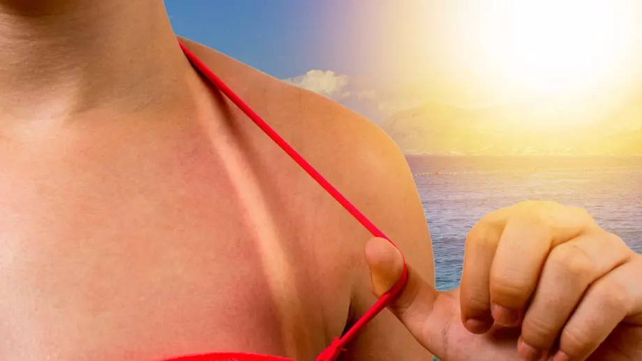 Повече за слънчевото изгаряне