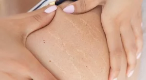 Домашен крем против стрии