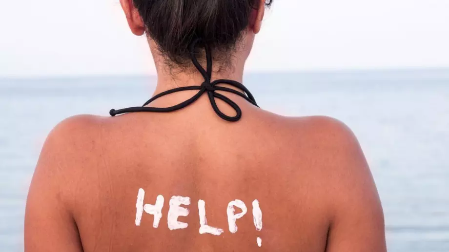 Тези продукти вкъщи много помагат при изгаряне