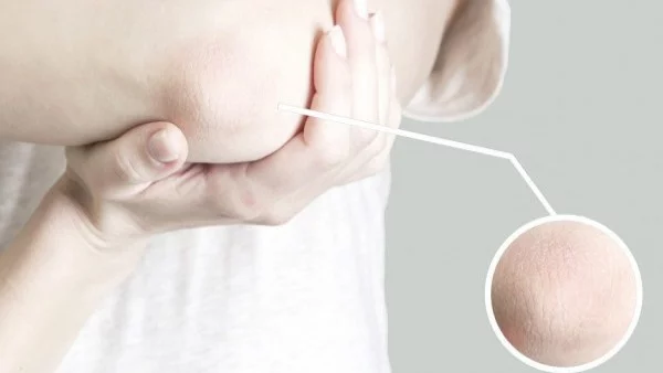 Мед при суха кожа на лактите