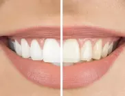 Направете зъбите си по-бели само за 2 минути