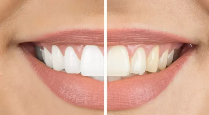 Забравете за зъболекарите: Ето как да избелите зъбите си у дома