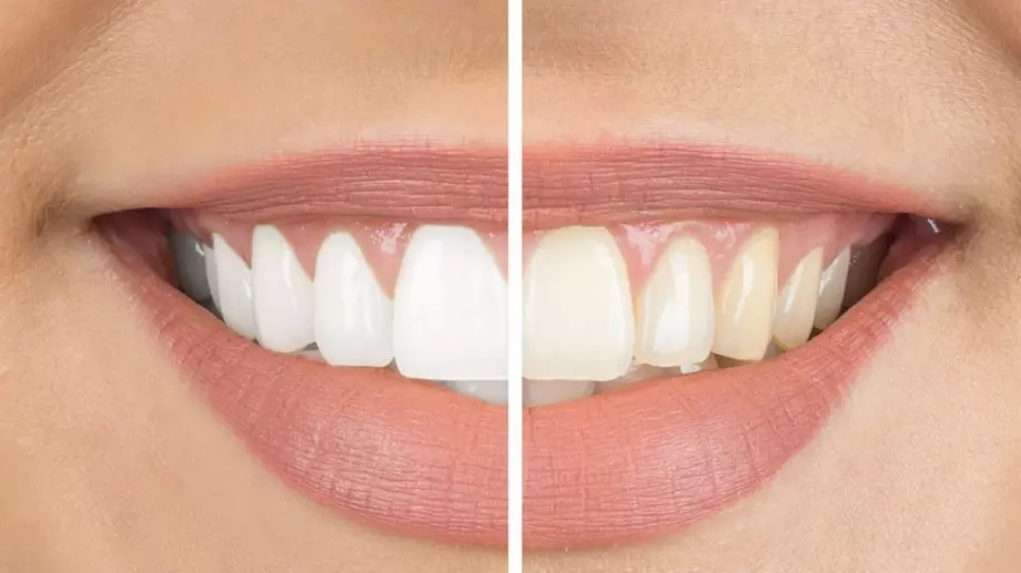 Забравете за зъболекарите: Ето как да избелите зъбите си у дома