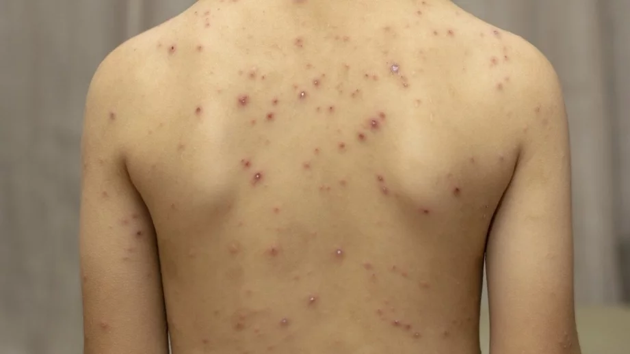 460 болни от морбили в България, 20 от тях - медицински служители