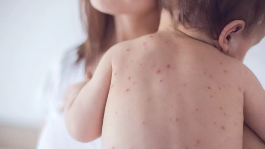 Изпитани бабини рецепти при лечение на варицела