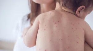 Увеличават се случаите на морбили в България