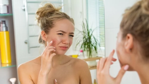 7 начина да излекувате акне без козметика