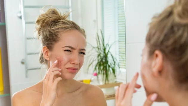 5 съвета за справяне с акнето