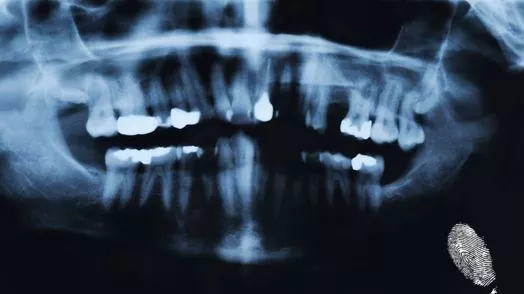 Падащи зъби