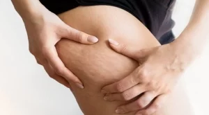 6 начина да се справите с досадния целулит