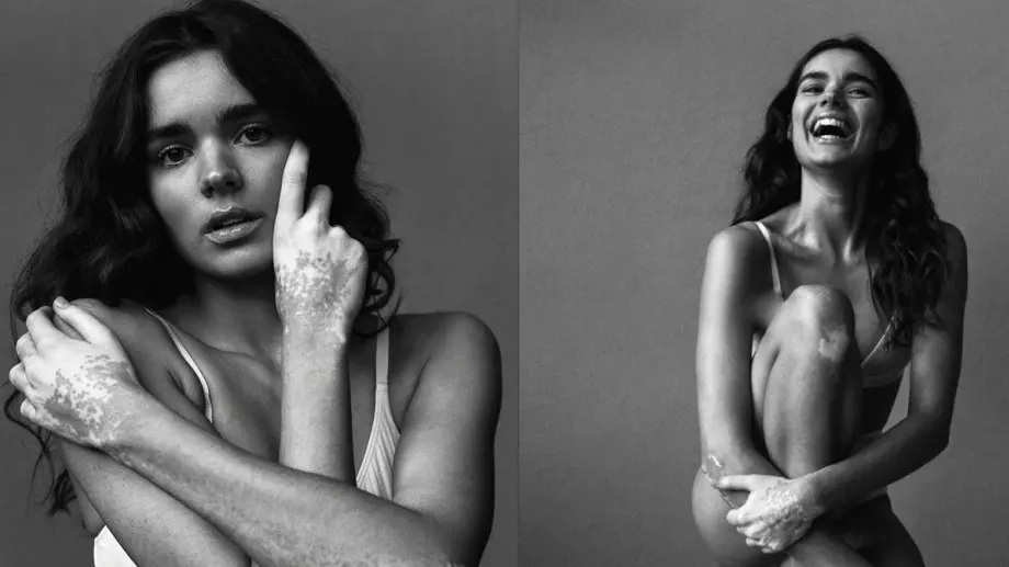 Фотограф улавя красотата на жени с витилиго