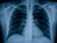 Пулмолог: Задължително пречистете така дробовете си, ако сте боледували скоро