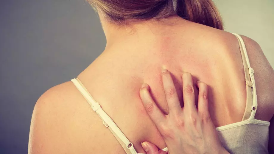 Акне по гърба: Защо, кога и как се третира