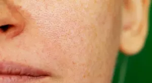 Експертите съветват: Как да свиете порите на лицето си