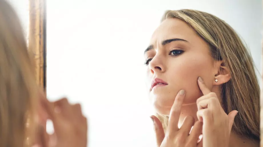 Причините за акне и кои са нещата, за които грешим, че го причиняват