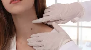 Защо излизат бенки и какво трябва да знаете за тях