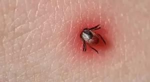 5 неща, които никога не трябва да правите при вадене на кърлеж