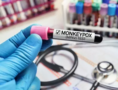 Медици разказаха за нетипични поражения на гениталиите при мъже с маймунска шарка