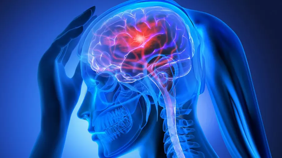 Научи симптомите на инсулт! Всяка минута е ценна!