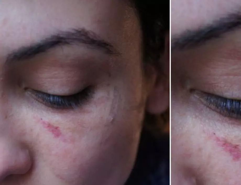 Диана Димитрова показа нови снимки на лицето ѝ със следа от грайфер (СНИМКИ)  - Новини от Actualno