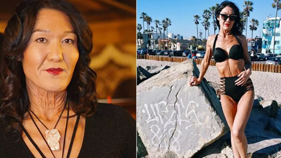 Жена с рядко кожно заболяване учи хората да обичат себе си различни (СНИМКИ)