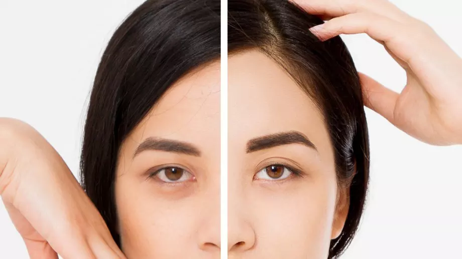 Натурална смес срещу тъмни кръгове под очите