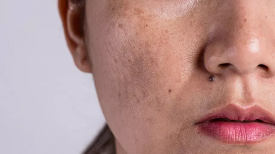 5 ефективни продукта при кожа с пигментация 