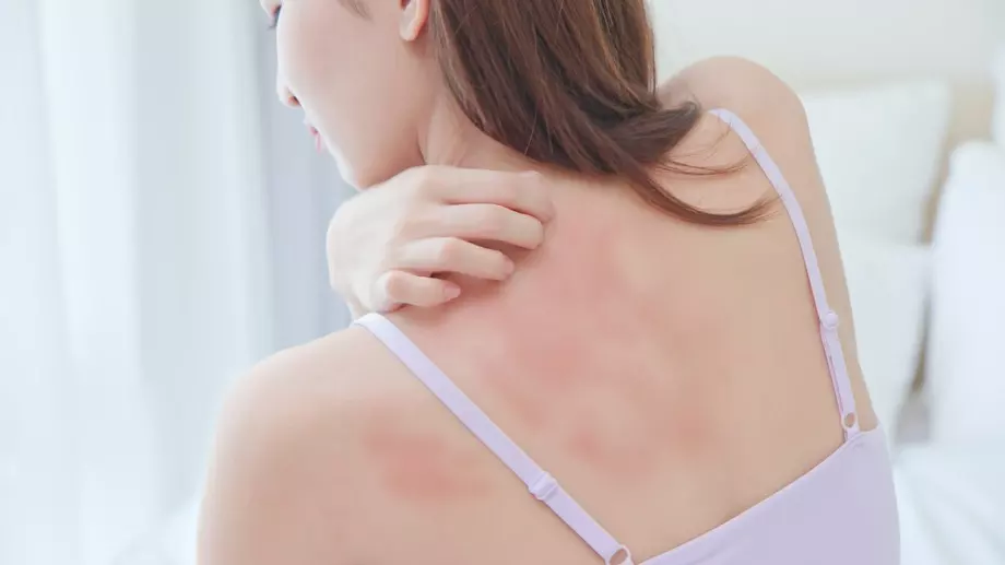 Всичко, което трябва да знаете за уртикарията 