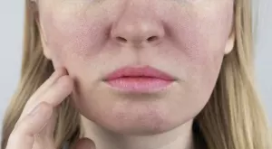 5 натурални средства за кожа с разширени пори