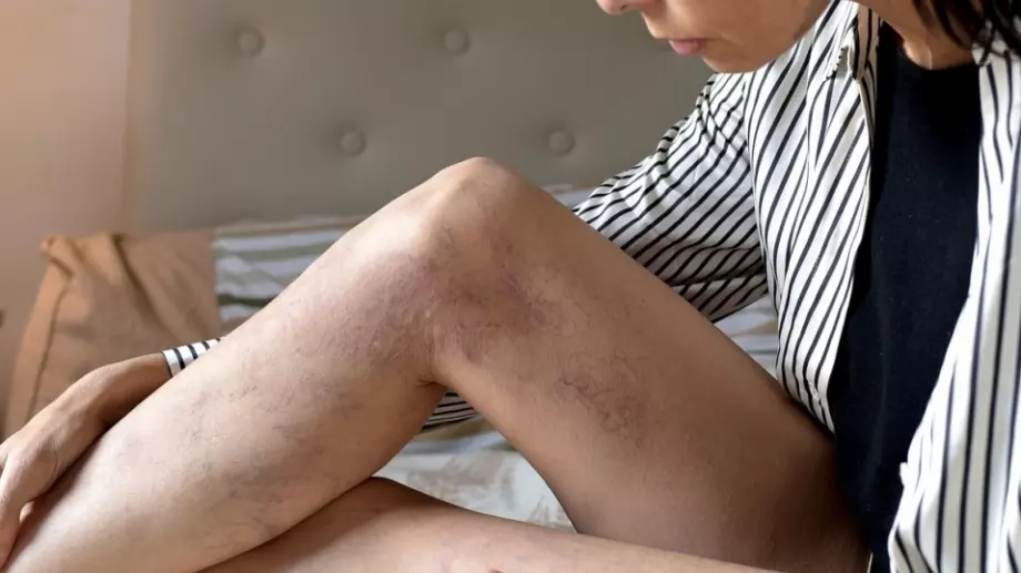 5 упражнения, помагащи при разширени вени