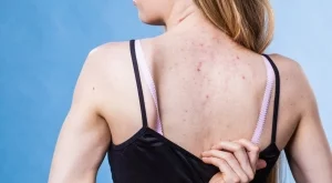 Топ съвети: Как да се отървете от акнето по кожата