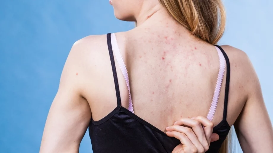 Топ съвети: Как да се отървете от акнето по кожата
